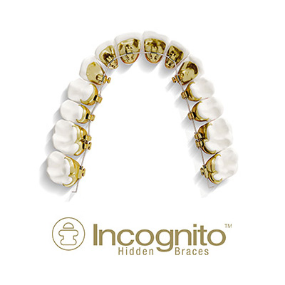 ¿Cómo lograr una sonrisa espectacular con la ortodoncia lingual de Incognito® ?