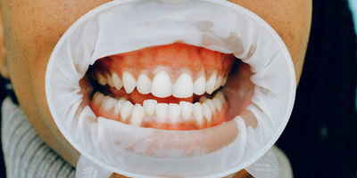 dientes mal colocados con apiÃ±amiento que requieren ortodoncia invisible