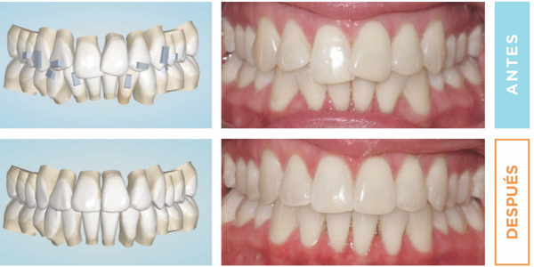 antes y despues ortodoncia invisible spark opiniones