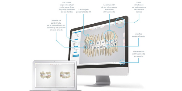 Software Spark 3D Approver ortodoncia invisble