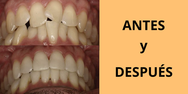 arcos linguales ortodoncia